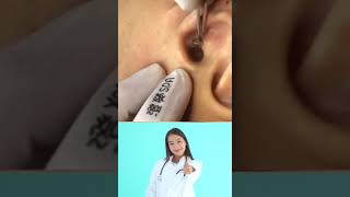 Dr.Nattacha, ear blackheads extraction.