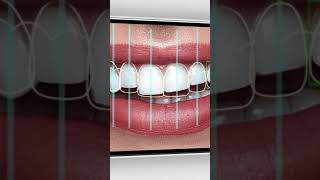 SMİLE DESİGN PROGRAMLARIYLA SADECE KİŞİYE ÖZEL GÜLÜŞ TASARIMLARI YAPABİLİYORUZ #smiledesign #dentist