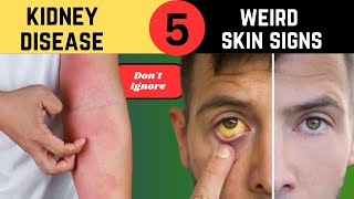 five singe of kidney disease on your skin||5 Skin Signs That Could Indicate Kidney Problems||