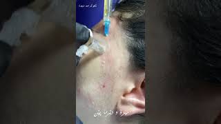 بەکارهێنانی میزو دێرما پێن بۆ کەمکردنەوەی کونیلە و چاڵی پێست.#dermapen