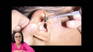 Dr.Natacha, satisfying relaxing video earwax removal.