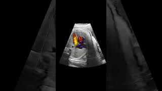 30 weeks of gestation came for Fetal Echo