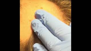 Subnovii Mole Removal