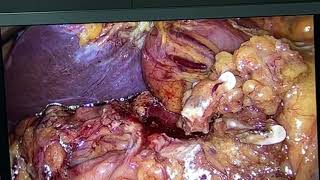 LIVE Laparoscopic Whipple procedure for periampullary tumor / CANLI laparoskopik Vippl emeliyyati