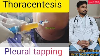 Pleural fluid tapping #thoracentesis #pleuraleffusion #pleuralfluidaspiration.