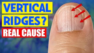 The Real Causes Behind Vertical Ridges On Nails Unveiled