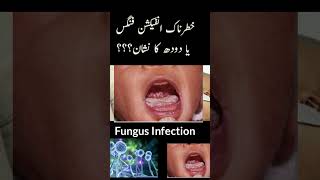 Baby Mouth Ulcer Treatment| Fungal Infection