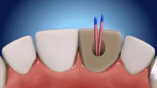 Как пломбируют зубы корневые каналы? Как лечат зубы?