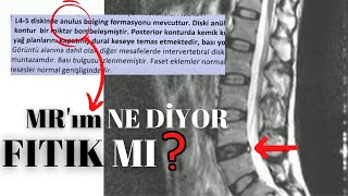 Bel Fıtığı MR Yorumlama | Dejenere | Bulging  | Protrüzyon | Ekstrüzyon | Sekestre Disk Ne Demek ?