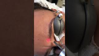 Eyebrow microblading tattoo removal