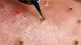 Full Giant Blackheads Popping Video, Blackheads Removal 2019