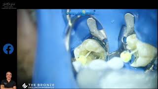 EASYINSMILE SPEAKER DR.OMAR MEXICO CLINIC VIDEO USING EASYINSMILE ENDO ACTIVATOR AND X-ROOT SEALER