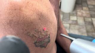 Laser tattoo removal on upper arm