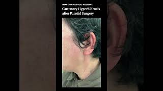 Images in Clinical Medicine: Gustatory Hyperhidrosis after Parotid Surgery