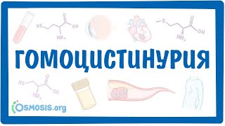 ГОМОЦИСТИНУРИЯ — причины, симптомы, патогенез, диагностика, лечение