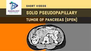 Solid pseudopapillary tumors (SPT) of the pancreas  #Umamaheshwar reddy. V