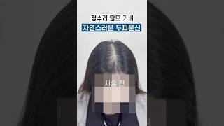 정수리 탈모, 두피 문신 후기 (feat. 여성 가르마 커버 전후)