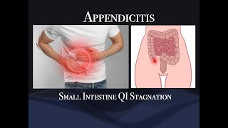 #TCM , Traditional #Acupuncture for #appendicitis  , Stagnation of qi in Small intestine