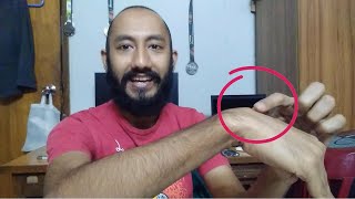 My Experience With Ganglion Cyst (Bangla)