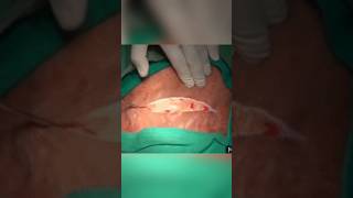 C - section delivery#cesarean delivery#youtubeshorts#viral#shorts#short#viralvideo#shortvideo