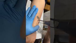 Co2 laser Plus Picolaser for Tattoo Removal