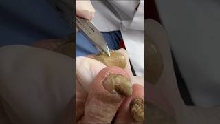 (SPED UP) Cutting Crumbly, Thick Nails On 90 Year Old Patient! #shortsvideo #nails #shortsvideoviral