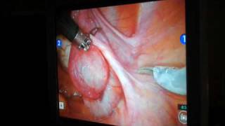 Sherman Hysterectomy Using da Vinci Technology