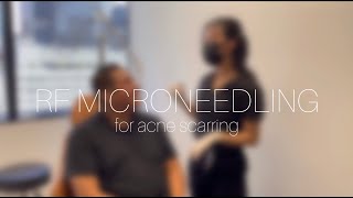 RF MICRONEEDLING FOR ACNE SCARRING | METROPOLIS DERMATOLOGY