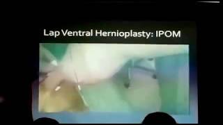 Laparoscopic ventral hernioplasty IPOM intra peritoneal onlay mesh repair hernia surgery method cme