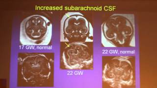 Prenatal MRI In The Diagnosis Of Malformations Of Cortical Development - Liat BEN SIRA Part 2