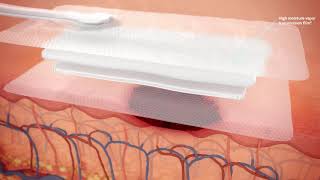 How PICO sNPWT works on open wounds