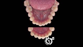 اصلاح طرح لبخند و انحراف خط وسط دندان ها | دندانپزشکی ترنج و یا unique smile