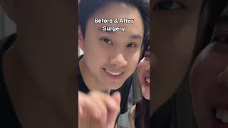 before & after surgery