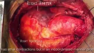 Atrial fibrillation vs Atrial Flutter