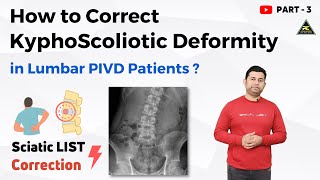 PHYSIOTHERAPY TREATMENT FOR SCIATIC LIST / SCOLIOSIS IN DISC PROLAPSE PATIENTS.