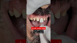 تجميل وتلبيس الاسنان