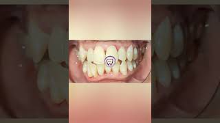 WDC - REMOVING GIANT TARTAR | SCALING GIGI | TARTAR | STAIN #shorts #dentist #drgwidya