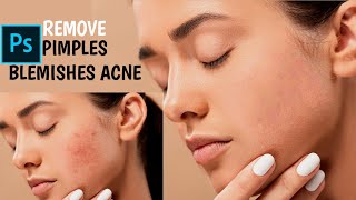 Remove pimples, Blemishes, Acne, Scars Easily and Quickly in photoshop 2021 | Smooth Skin | #Shorts