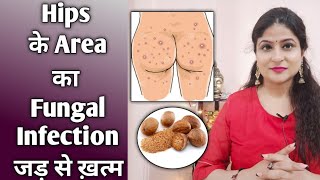 How To Treat Fungal infection Of Private parts | Home Remedy | fungal infection का घरेलू उपाय