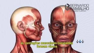 TOXINA BOTULÍNICA - BOTOX - DR BERNARDO RAMALHO