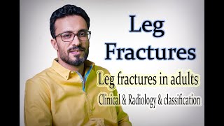 03 Leg fractures: Clinical & Radiology & Classification