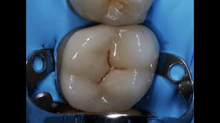 ZIRCONIA BONDING PROTOCOL : DEMONSTRATION WITH CLINICAL PICTURES, NARRATED WITH EVIDENCE.