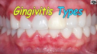 Gingivitis Types | Periodontal Disease Types (Gingivitis, Periodontitis)