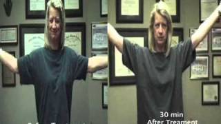 Frozen Shoulder Patient Before & After_5