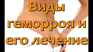 Виды геморроя: как выглядит, симптомы  и лечение