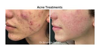 Acne treatment . Dr.Brunilda Bardhi Dermatologe flet per trajtimin e Akne Vulgaris , subcision