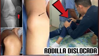 DISLOCACION DE RODILLA EN NIÑA DE 12 AÑOS (DISLOCACION DE ROTULA)/ 膝關節脫位 / ความคลาดเคลื่อนของหัวเข่า