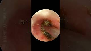 Earwax Stuck In The DEEPEST Corner