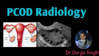 Polycystic ovarian morphology (PCOD radiology )