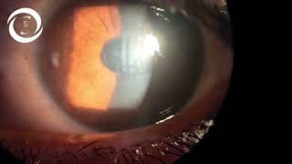 Corneal abrasion